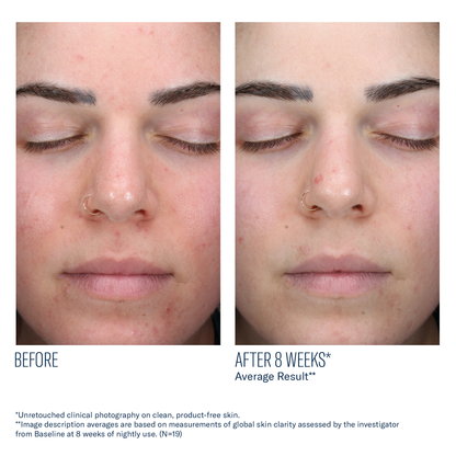 AlphaRet Clearing Serum