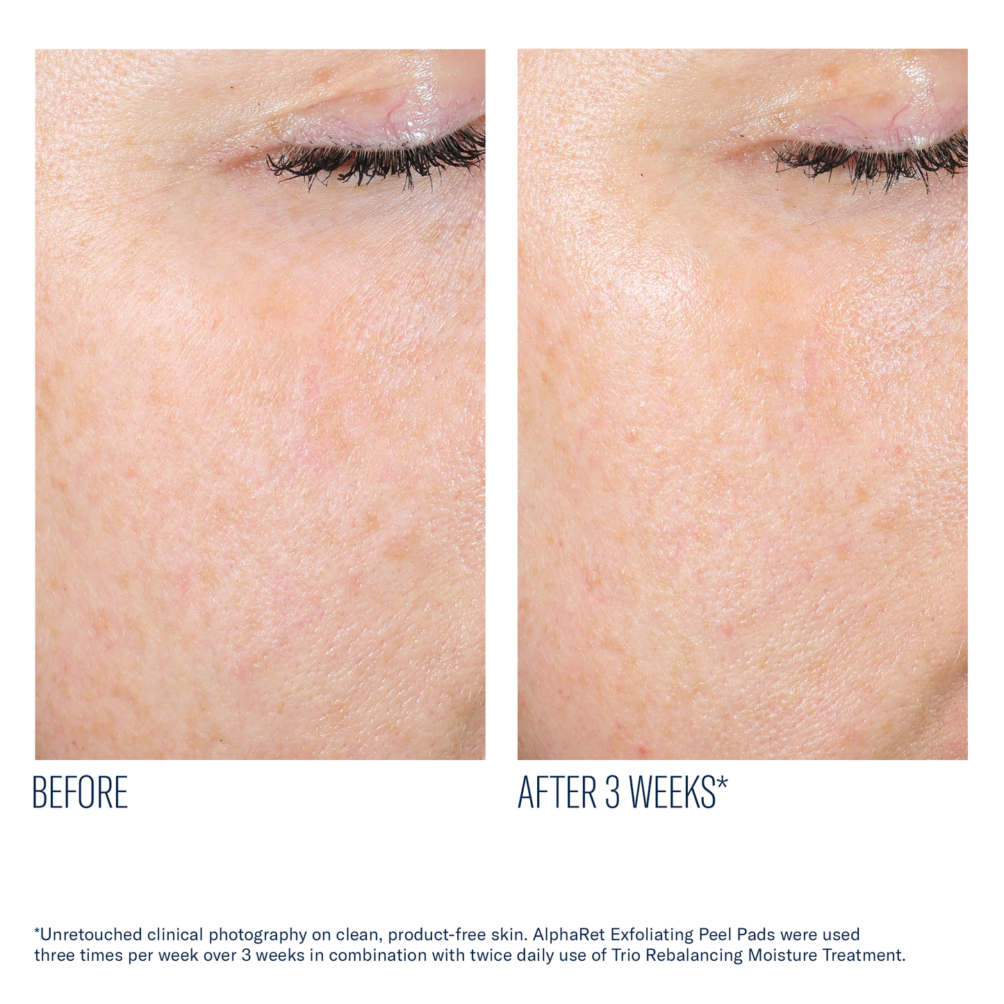 AlphaRet Exfoliating Peel Pads