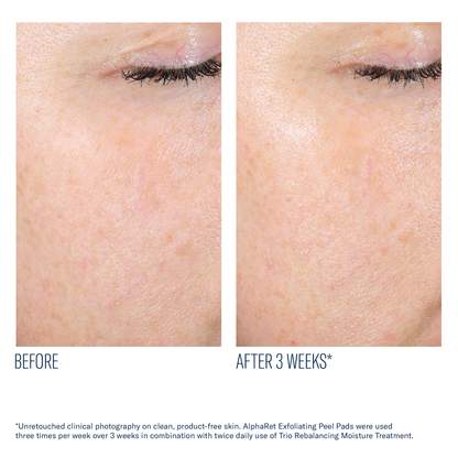 AlphaRet Exfoliating Peel Pads